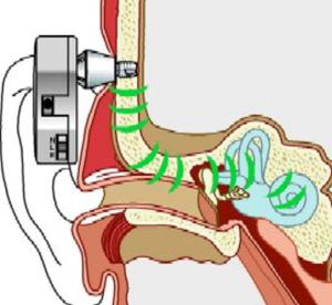 Schematic drawing of how the BAHA bone conduction implant works